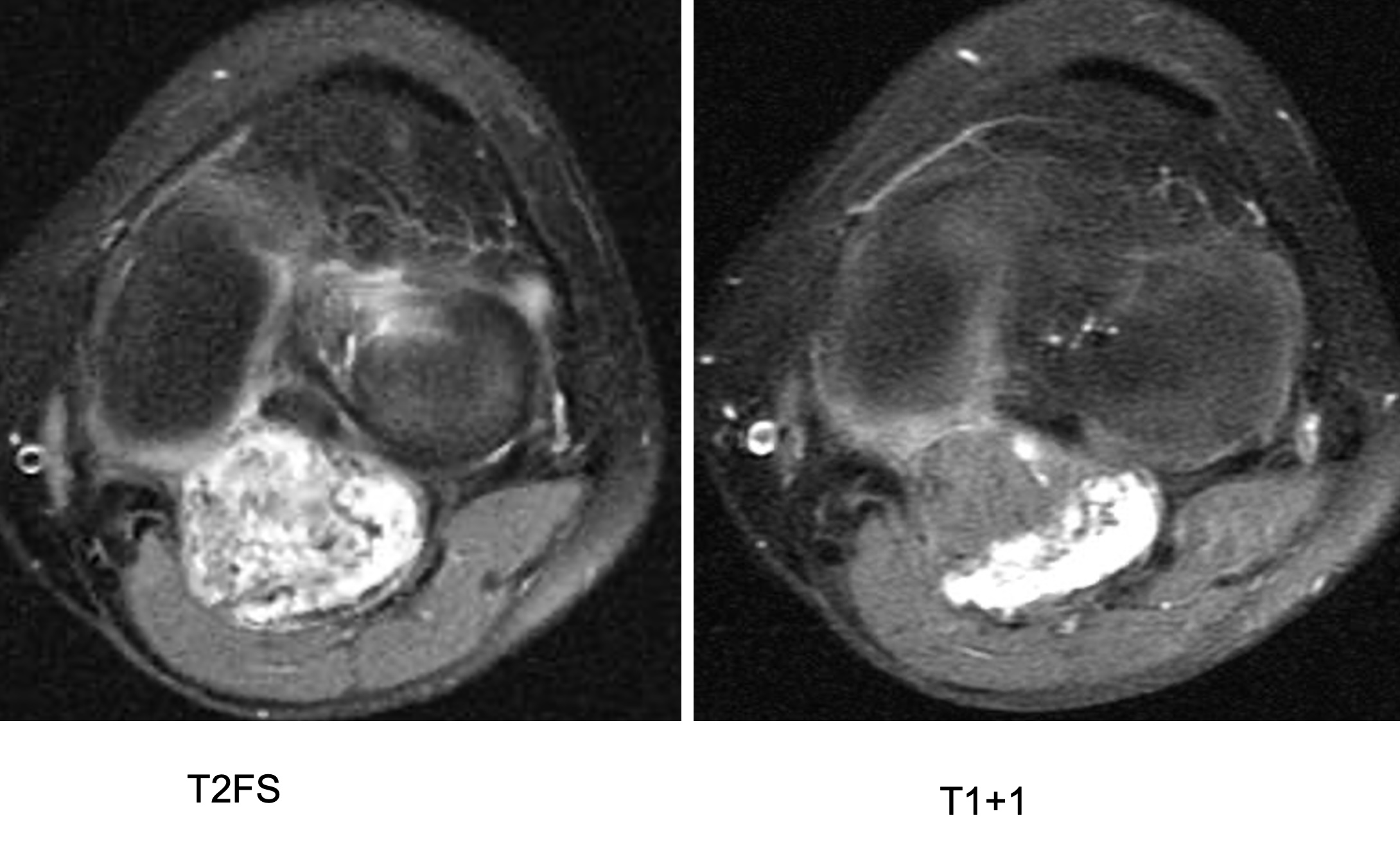 Figure 4 for case Synovial chondromatosis